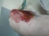 Surgical Incision Drain