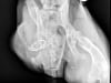 Rear leg amputee x-ray