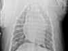 Lung Metastasis