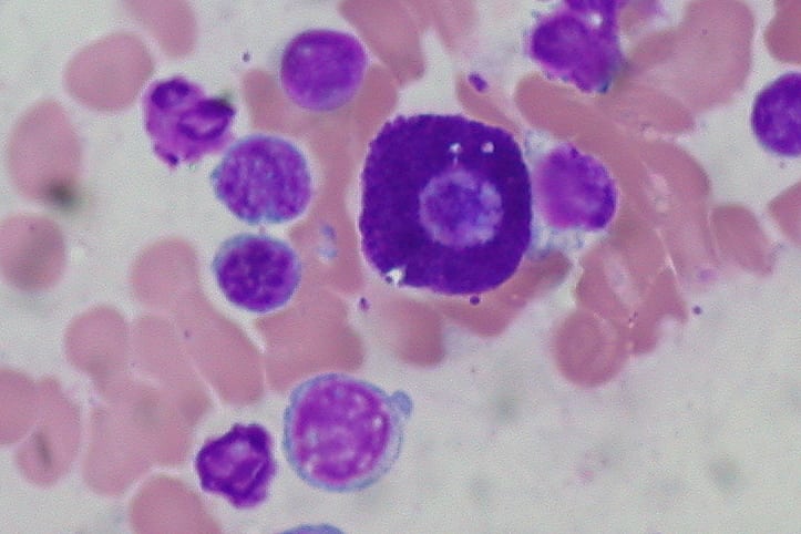 Mast_Cell,_Bone_Marrow_Aspirate,_Wright_Stain_(5916735712)