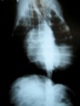 Chest X-ray of Jerry with large mass visible