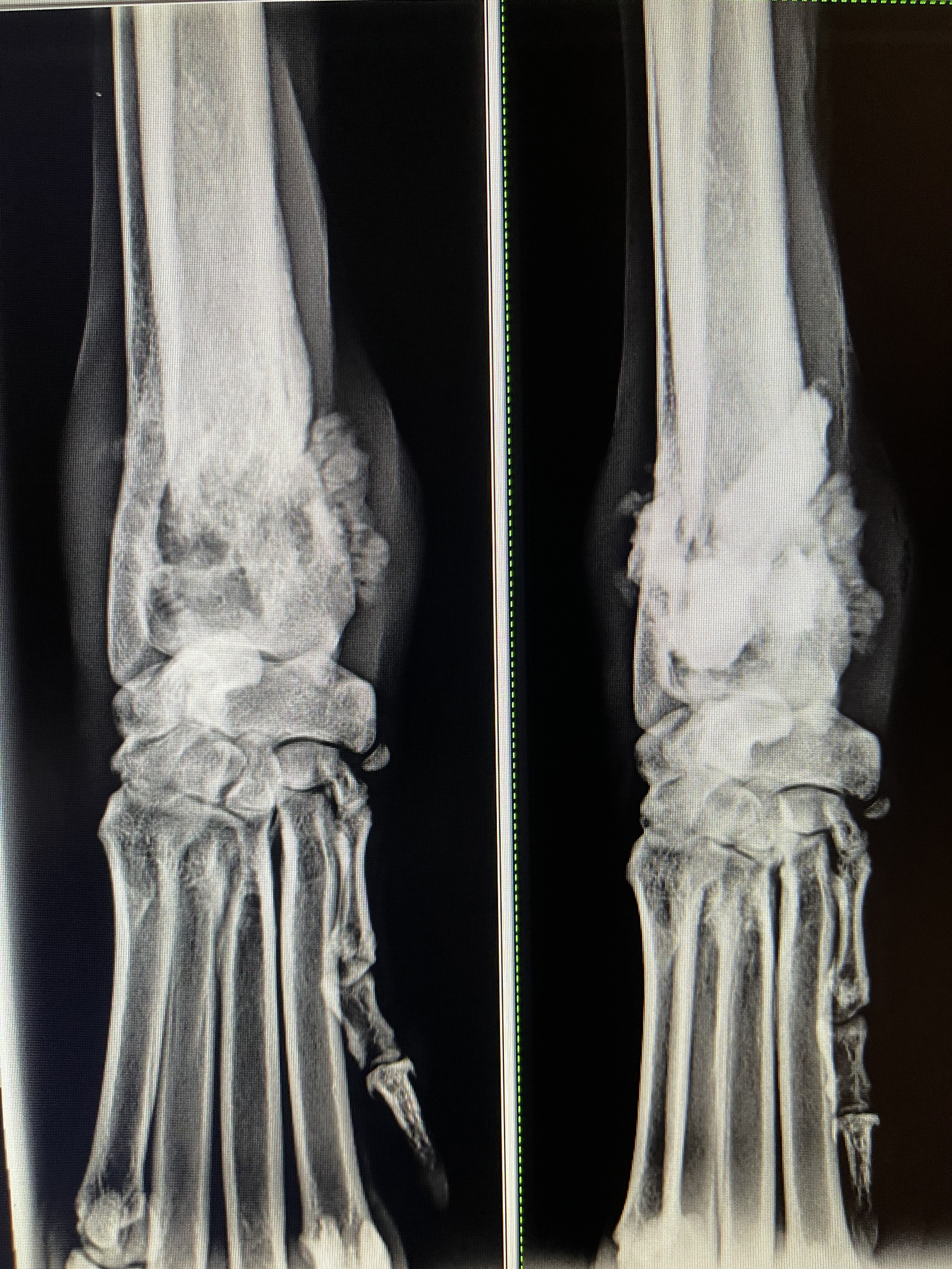Colt's cementoplasty osteosarcoma limb sparing results: before (left), after (right)