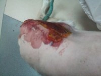 Surgical Incision Drain
