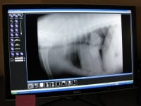 Digital chest x-ray shows reduction of osteosarcoma lung metastasis