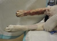 Bostonplasty Procedure