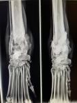 Osteosarcoma Bone Cancer Limb Sparing Results