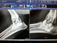 Osteosarcoma fracture