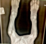 Tripawd Phoebe Broken Leg x-ray