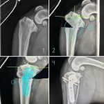 modified cranial closing wedge osteotomy (CCWO) on three legged dog