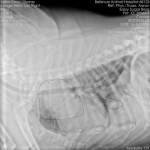 Lung Metastasis