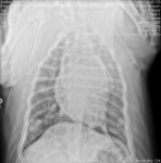 Lung Metastasis